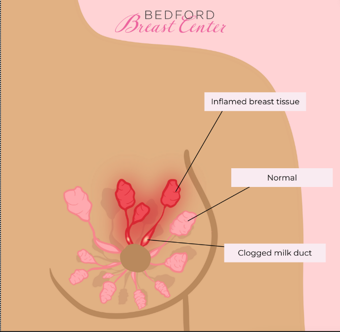 Why Do My Nipples Hurt? 6 Causes of Painful Nipples